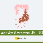 یبوست بعد از عمل لاغری