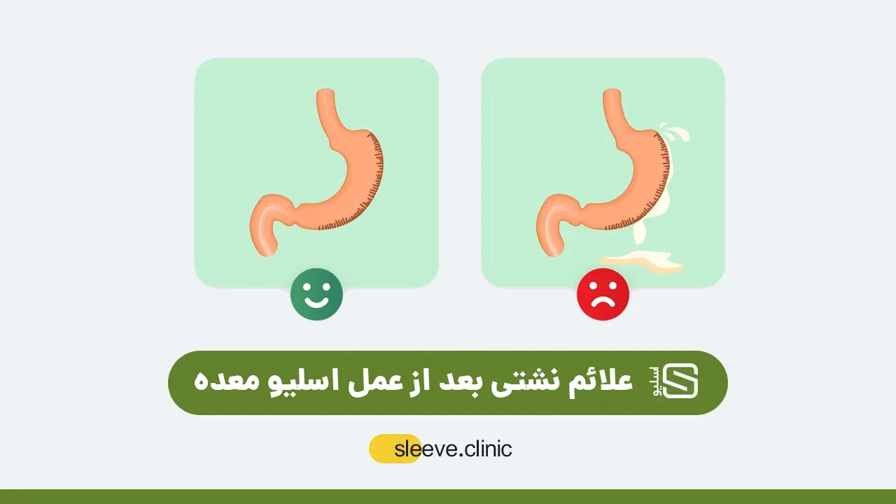 عکس شماتیک نشتی بعد از عمل اسلیو معده