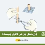 درن عمل لاغری