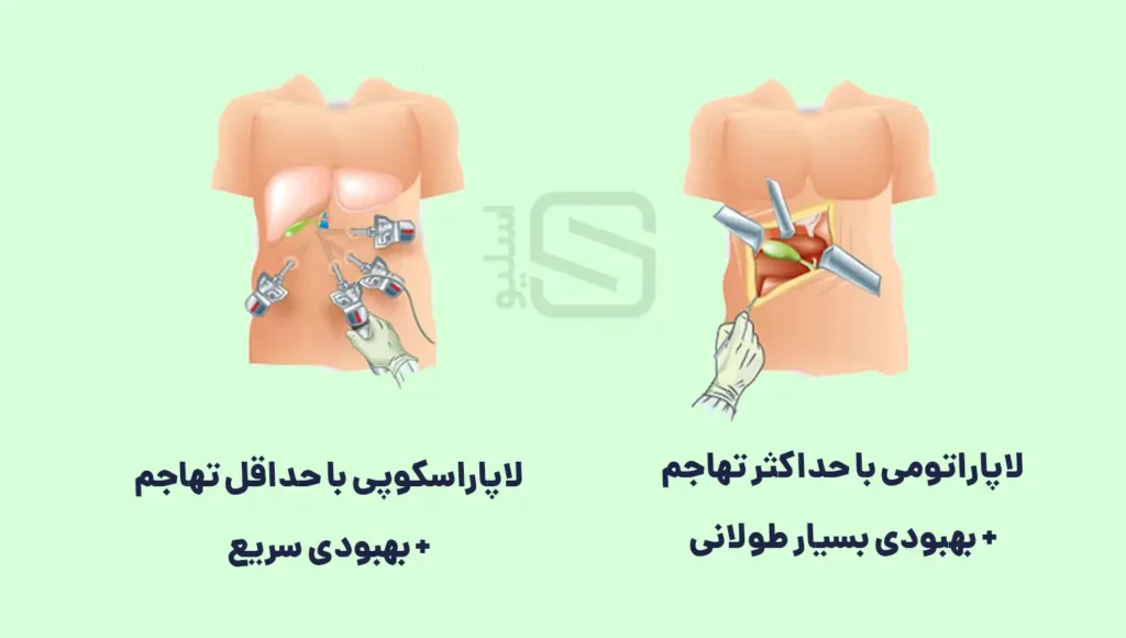 اینفوگرافی تفاوت لاپاراتومی با لاپاراسکوپی