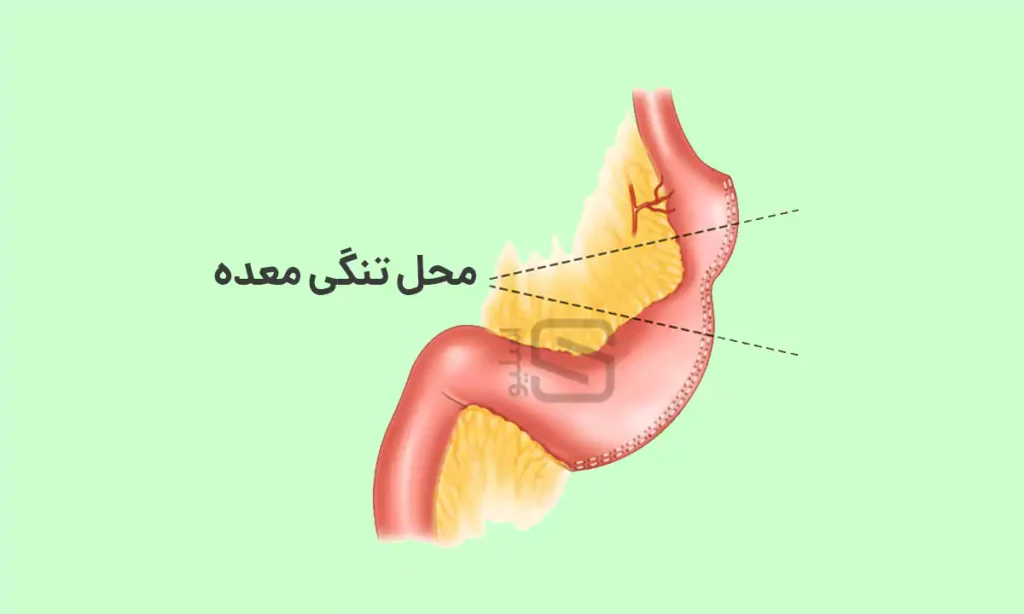 عکس شماتیک تنگی بعد از عمل: یکی از محتمل ترین عوارض اسلیو معده که توسط جراح کم تجربه انجام شده است