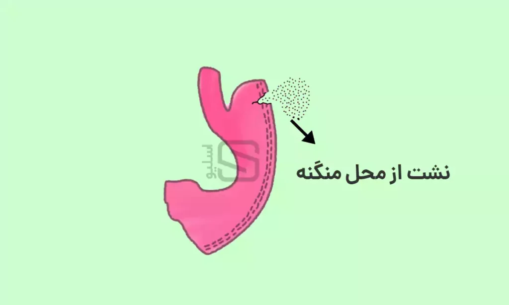 عکس شماتیک که نشان دهنده علائم نشت بعد از عمل اسلیو معده است