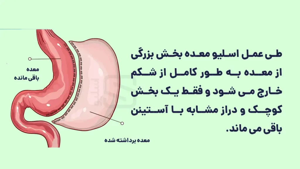 اینفوگرافی اسلیو معده چیست