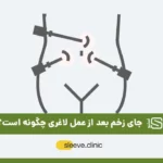 جای زخم بعد از عمل لاغری