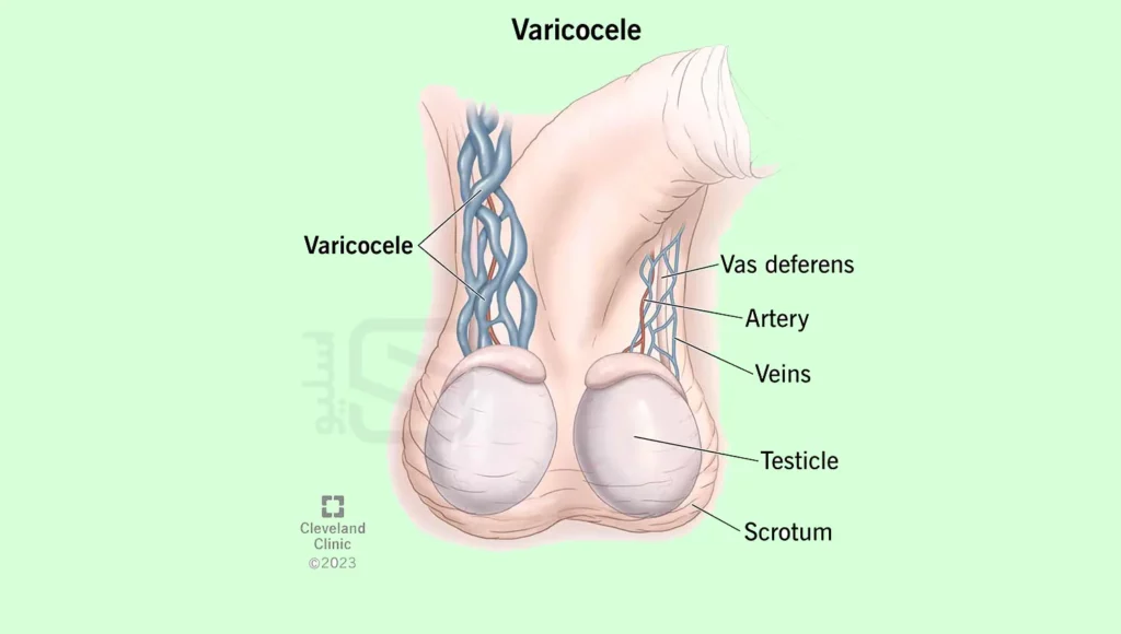 عکس واریکوسل شماتیک