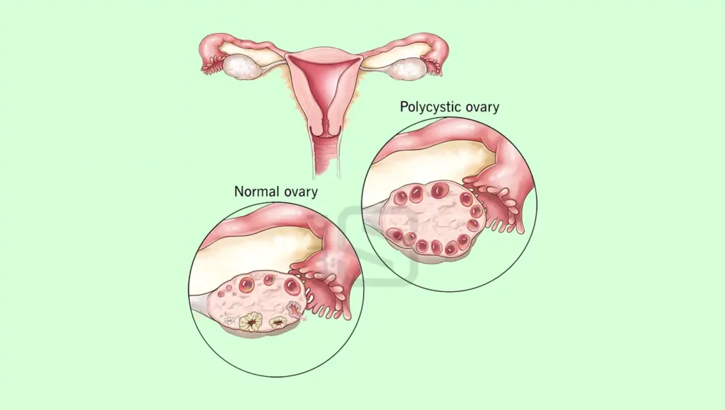 اینفوگرافی سندروم تخمدان پلی کیستیک (مقایسه تخمدان سالم و پلی کیستیک)