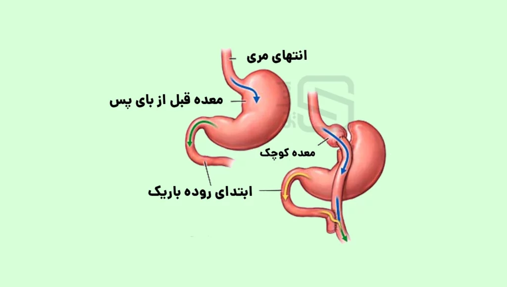 تصویر شماتیک عمل بای پس معده با توضیحات