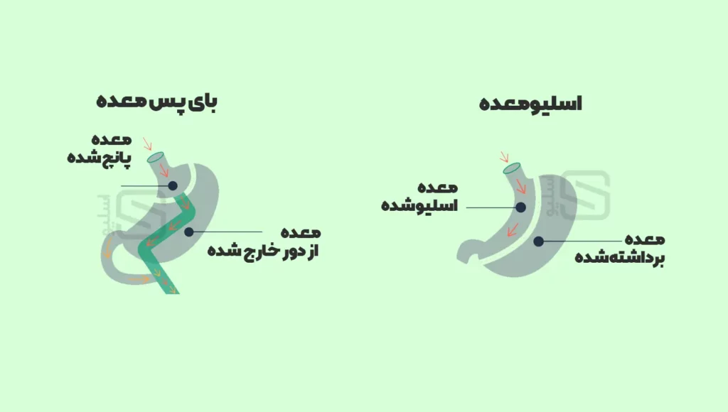 مقایسه عمل اسلیو معده و بای پس در قالب تصویر شماتیک