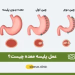 عکس عمل پلیسه معده