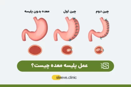 عکس عمل پلیسه معده