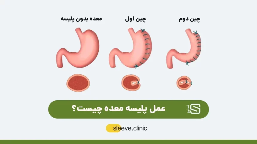 عکس عمل پلیسه معده