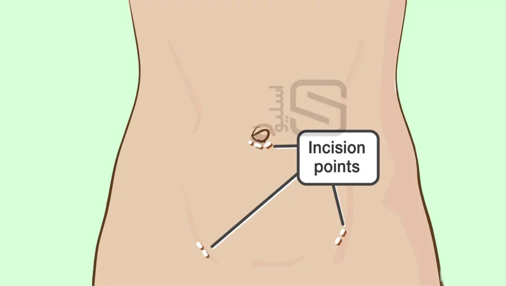 جای برش ها در جراحی لاپاراسکوپی