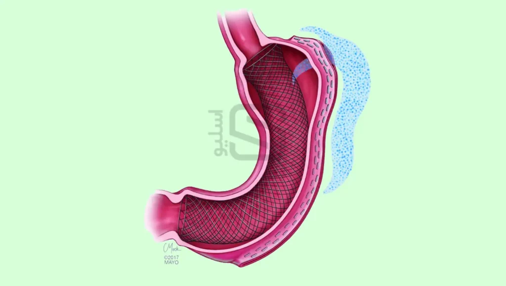 عکس شماتیک نشتی از معده بعد از اسلیو