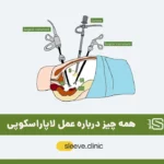عمل لاپاراسکوپی