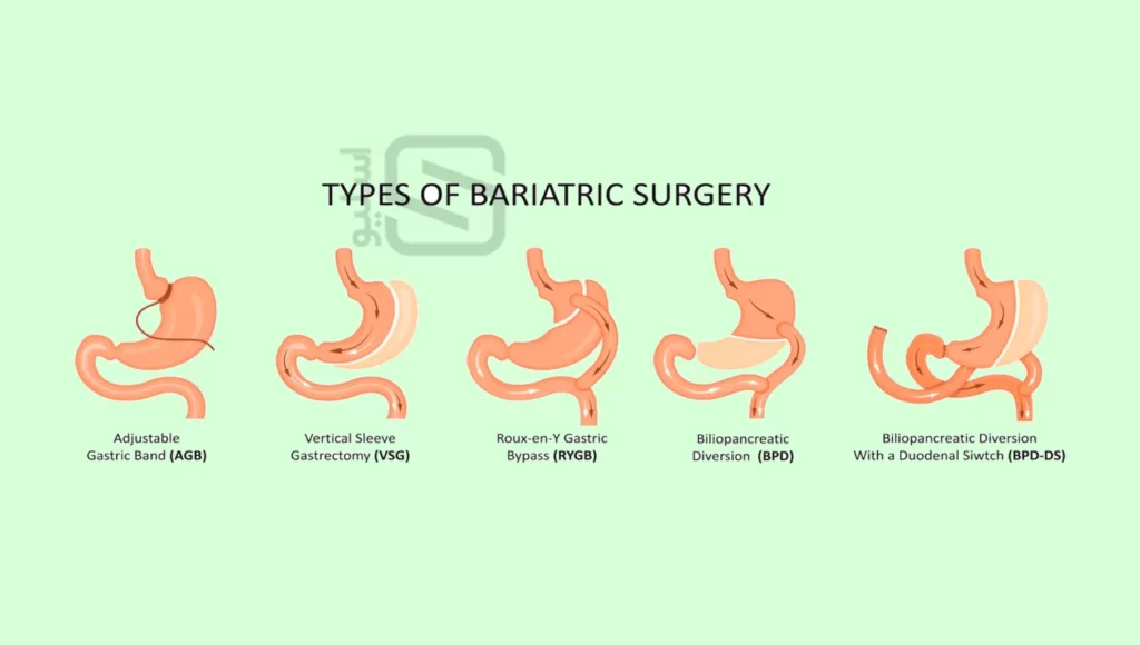 انواع عمل لاغری زا حلقه معده تا بای پس معده