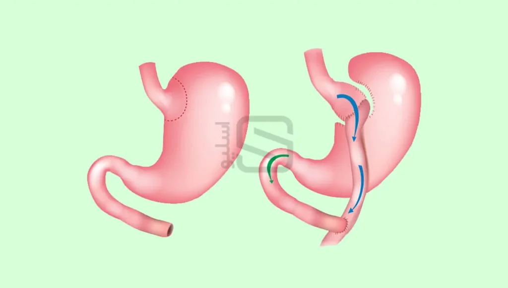 عکس شماتیک مسیر عبور مواد قبل و بعد از عمل بای پس معده