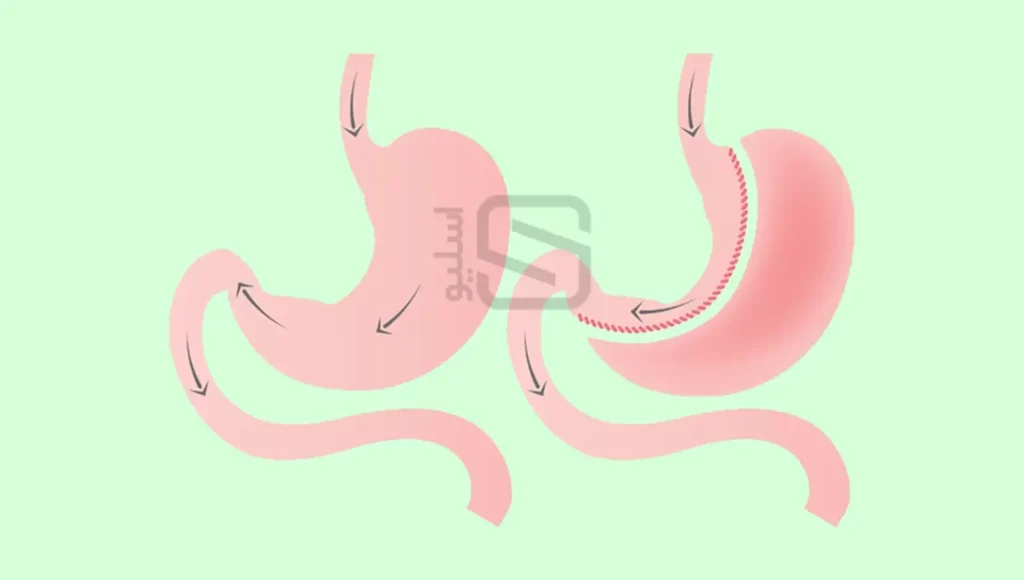 عکس شماتیک مسیر عبور مواد قبل و بعد از عمل اسلیو معده