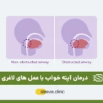 درمان آپنه خواب با عمل لاغری