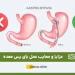 مزایا و معایب عمل بای پس معده تصویر شاخص