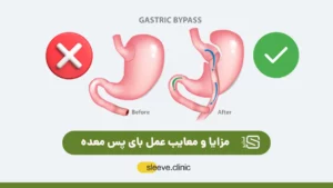 مزایا و معایب عمل بای پس معده تصویر شاخص