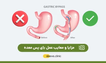مزایا و معایب عمل بای پس معده تصویر شاخص