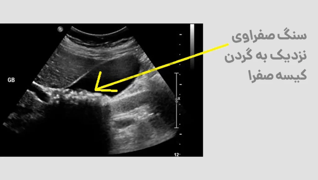 تشخصی سنگ کیسه صفرا با کمک سونوگرافی قبل از عمل لاغری