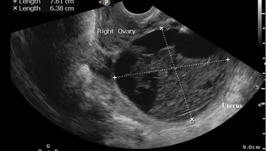 آزمایش سونوگرافی برای تشخیص کیست تخمدان