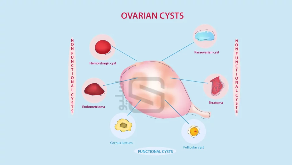 اینفوگرافی انواع کیست های تخمدان