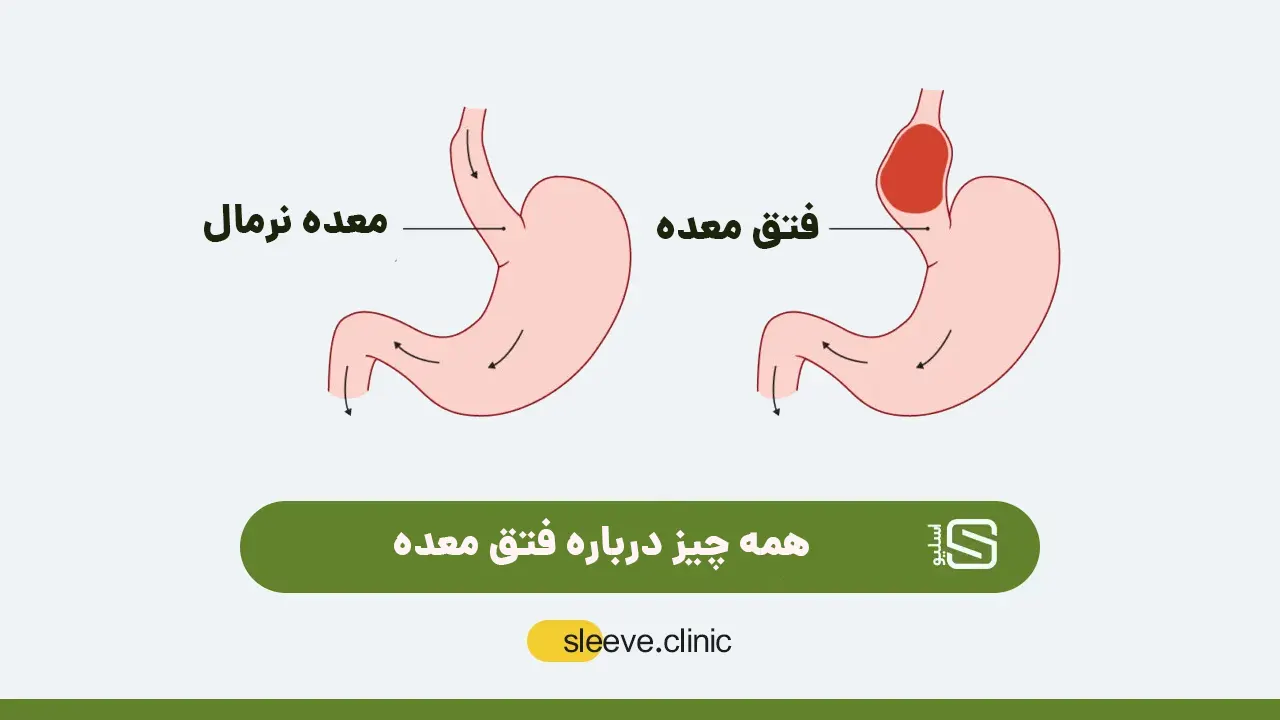 فتق معده چیست؟(از علائم تا بهترین روش های درمانی) | کلینیک اسلیو