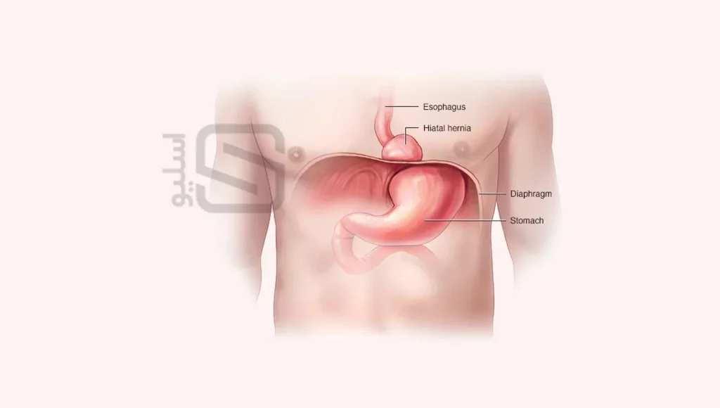 عکس شماتیک فتق معده