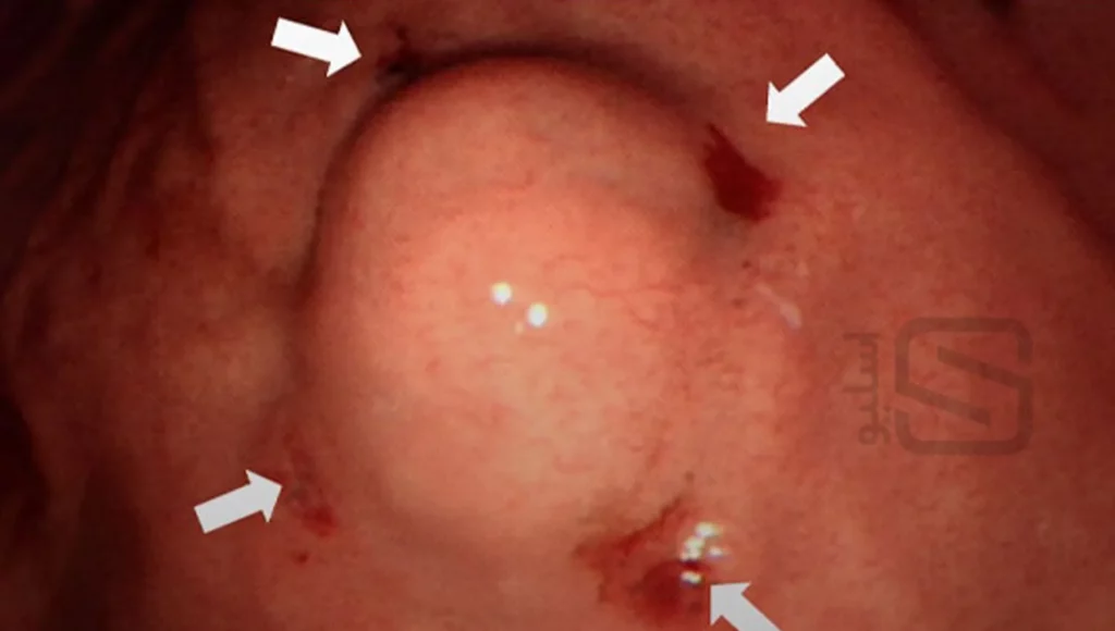 عکس سرطان خوش خیم معده