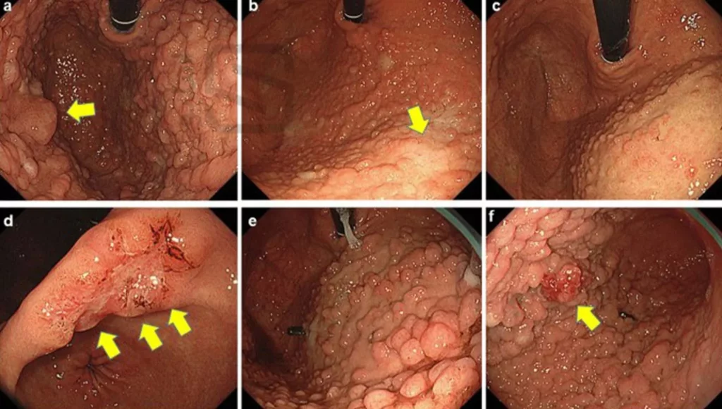 عکس سرطان بدخیم معده
