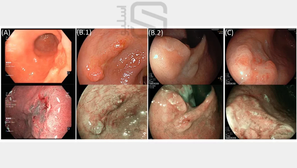 عکس تومورهای معده