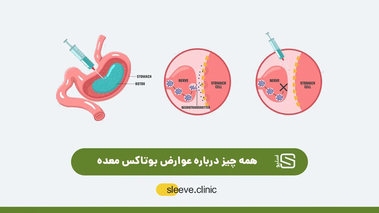 بعد از عمل بای پس چقدر وزن کم میکنیم+بعد از بای پس چه میوه هایی بخوریم+نظرات افرادی که بای پس انجام دادن+عوارض بوتاکس معده