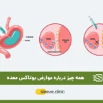 عوارض بوتاکس معده عکس