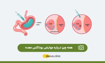 عوارض بوتاکس معده عکس