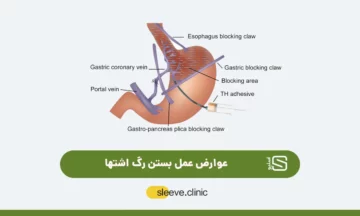 عکس شاخص بستن رگ اشتها