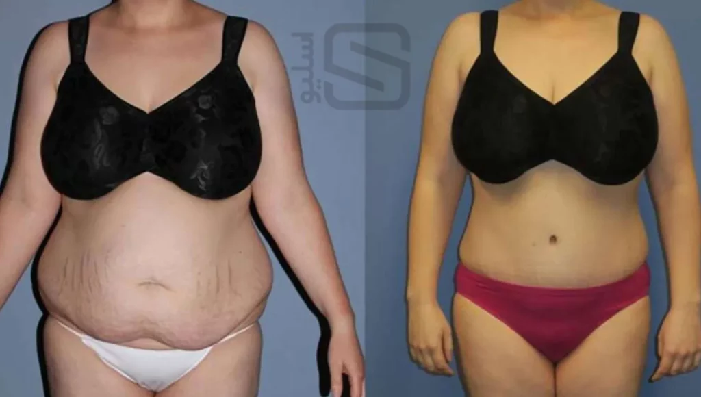 عکس قبل و بعد لیپوساکشن شکم