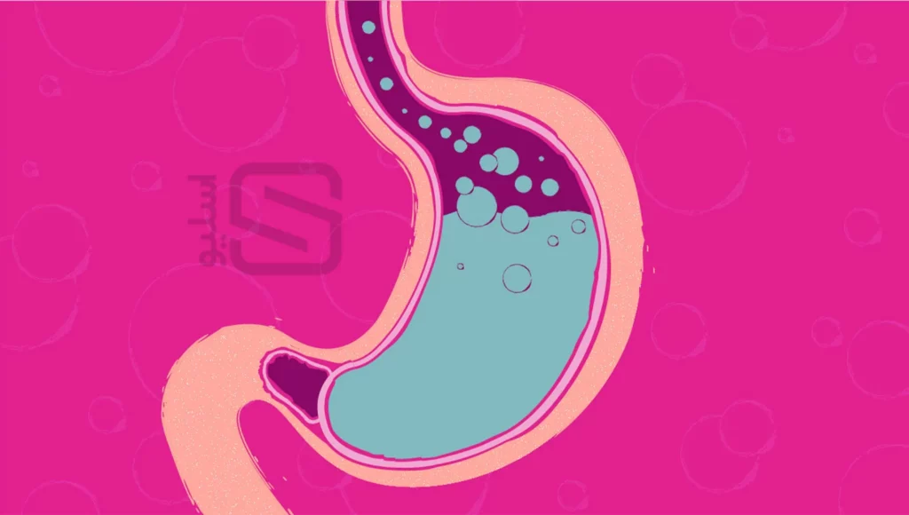 برگشت اسید معده به سمت مری