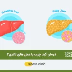 درمان کبد چرب با عمل لاغری