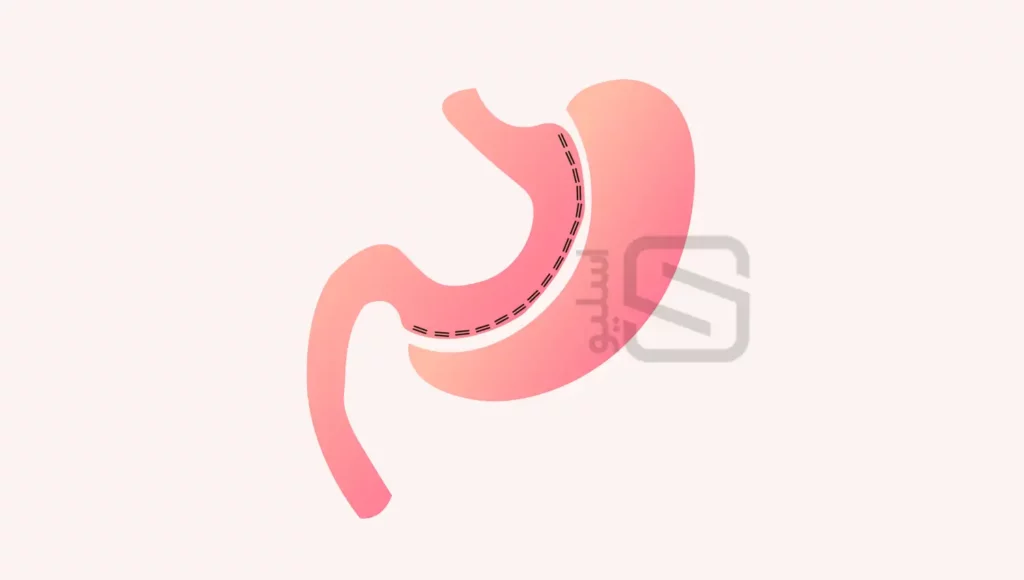 عمل اسلیو معده