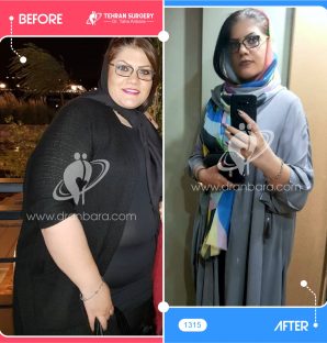 بیمارانی که عمل اسلیو انجام داده اند