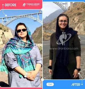 قبل و بعد بیماران پس از اسلیو