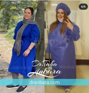 تجربیات بیماران پس از انجام عمل اسلیو