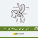 عمل مینی بای پس معده