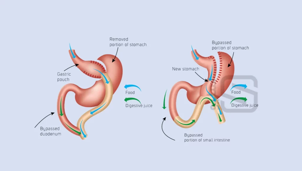 عمل بای پس معده