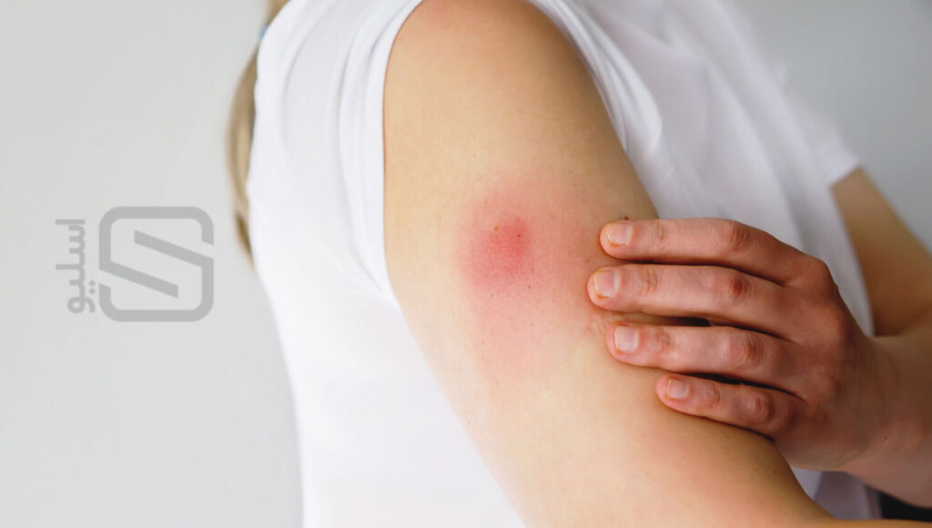 قرمزی ناحیه تزریق آمپول ویکتوزا