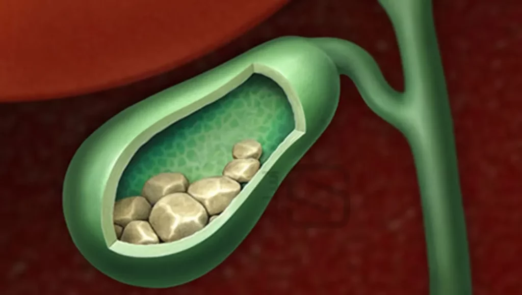 تشکیل سنگ کیسه صفرا