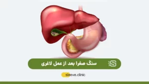 سنگ کیسه صفرا پس از عمل لاغری شاخص