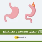 سوزش معده پس از عمل اسلیو